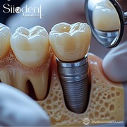 The Benefits of Basal Implants: Enhanced Stability and Quick Recovery 